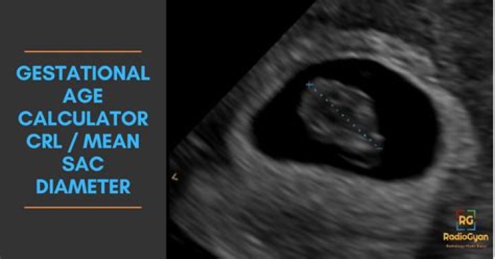 What does a collapsed gestational sac mean?